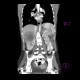 Renal cell carcinoma, infiltration of liver: CT - Computed tomography